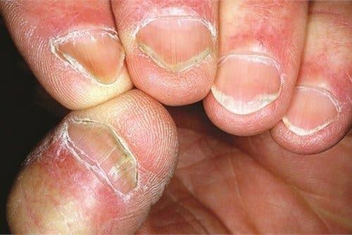 Le syndrome d'Hallopeau provoque une altération de la peau et des ongles
