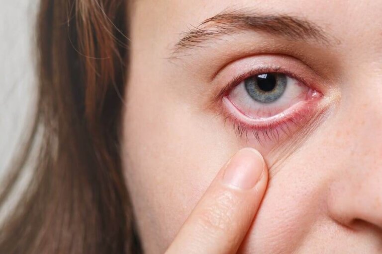 5 remèdes efficaces pour les infections oculaires