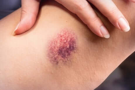 La thrombophlébite superficielle et les ecchymoses