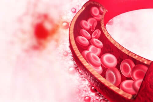 Dysplasie fibromusculaire : diagnostic et traitement