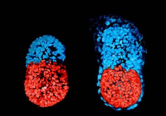 Embryon parasite et fœtus in fœtu