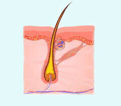 L'épithélioma calcifié de Malherbe