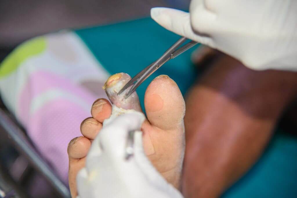 La gangrène diabétique peut toucher le pied