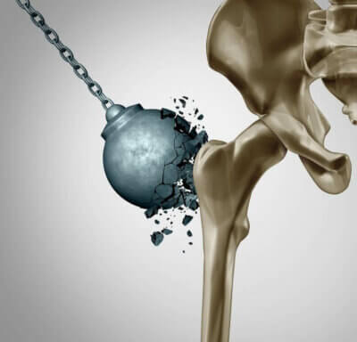 Réduire les dommages de l’ostéoporose après la ménopause