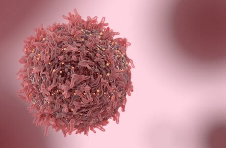 Zoom sur un épithélioma calcifié de Malherbe