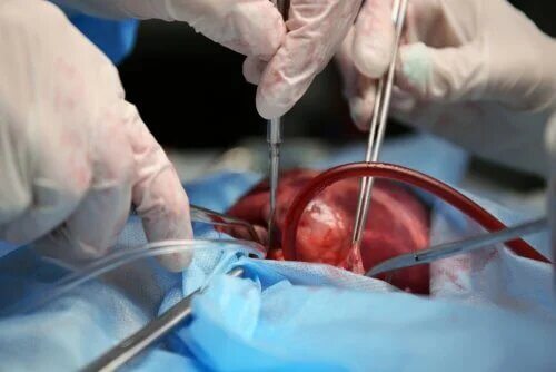 La transplantation cardiaque est cependant aujourd'hui une opération relativement sans danger