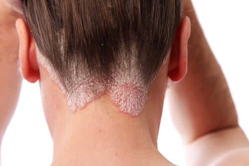 Une femme ayant des plaques de psoriasis du cuir chevelu
