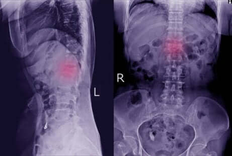 La radiographie d'une spondylolisthésis