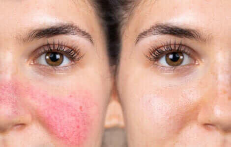 La réactivité de la peau d'une femme.