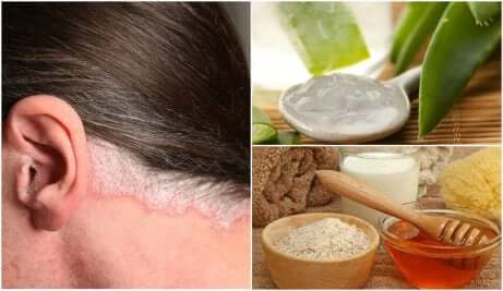 Des remèdes naturels contre le psoriasis du cuir chevelu