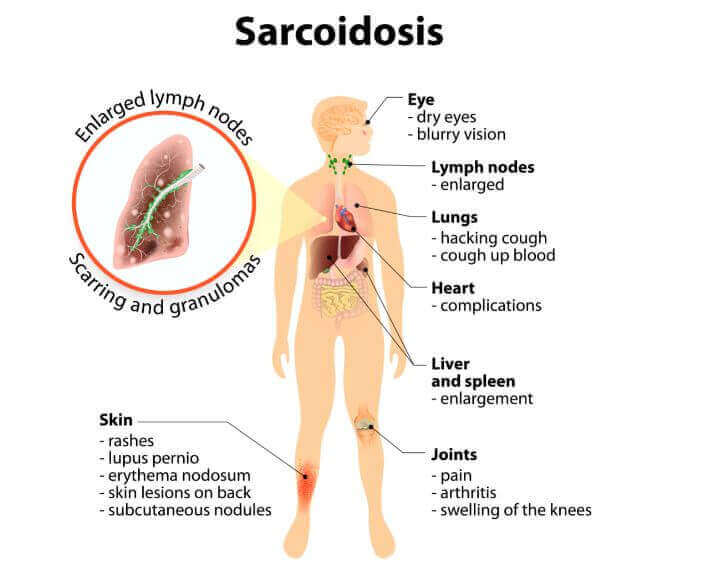 Qu'est-ce que la sarcoïdose : symptômes et traitements