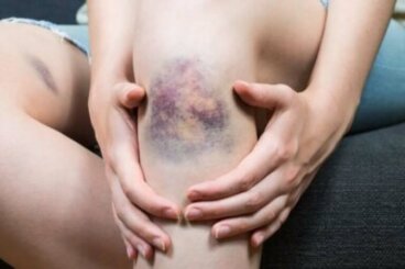 Quelles sont les causes de la thrombophlébite superficielle ?