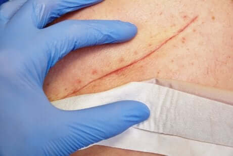 La chlorhexidine utilisée en tant qu'antiseptique topique.