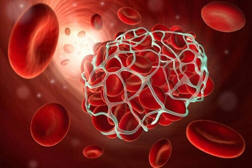 La thrombose peut être provoquée par la prise de contraceptifs hormonaux.