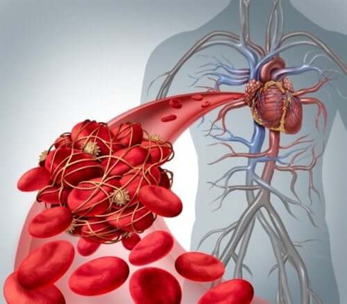 Prévenir la thrombose en évitant les caillots sanguins.