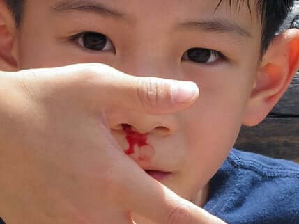 Un enfant qui saigne du nez.