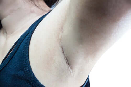 Qu'est-ce que le ganglion sentinelle ?