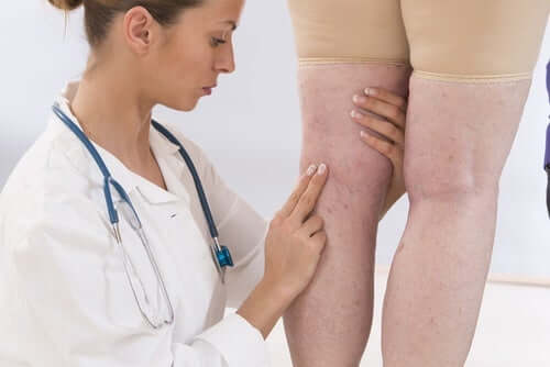 Jambes enflammées d'une femme.
