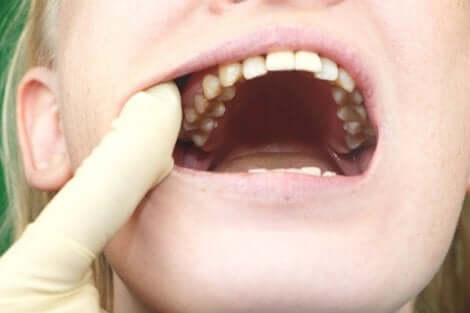 Il y a certaines bactéries qui causent des caries.