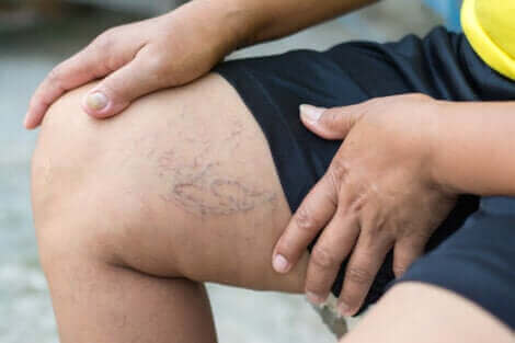 Les varices sur les jambes d'une personne.