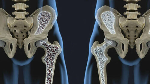 La fragilité des os augmente le risque d'ostéoporose.