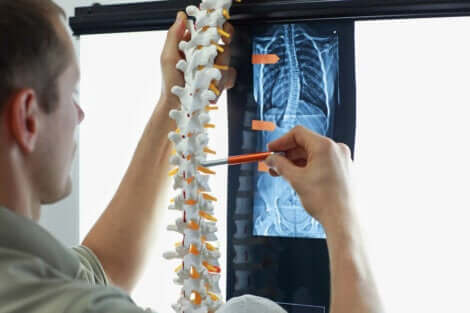 La radiographie d'une colonne vertébrale touchée par la scoliose.