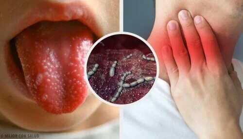 La scarlatine est une maladie difficile à vivre pour les enfants