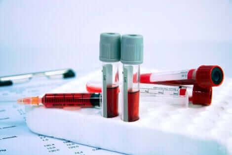 L'anémie peut être diagnostiquée via des tests sanguins.