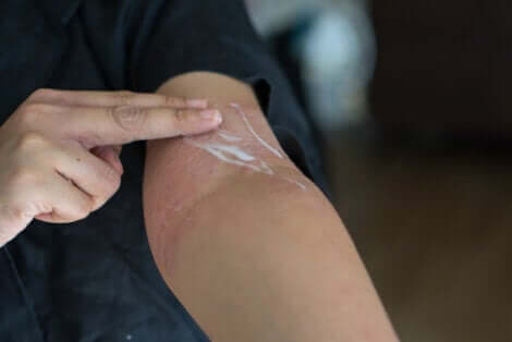 Une personne appliquant de la crème sur son bras pour lutter contre le rash cutané.