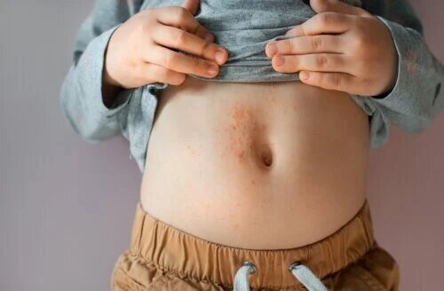 Comment traiter la dermatite atopique chez les enfants