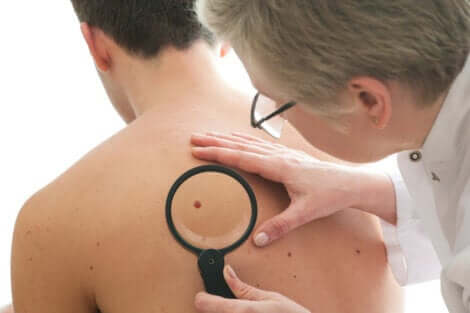 L'examen d'un dermatofibrome sur le dos d'un homme.