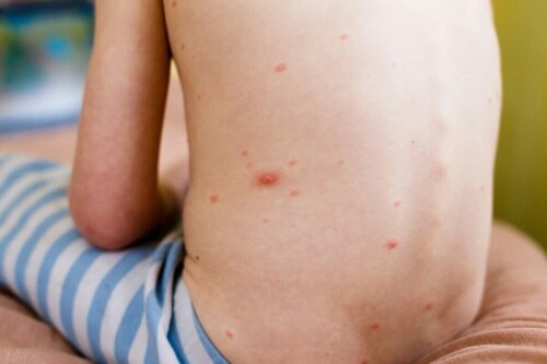 La dermatite chez les enfants.