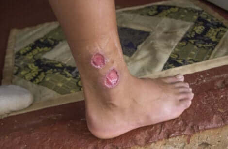 Un cas de leishmaniose cutanée.