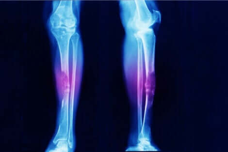 Radiographie des membres inférieurs.