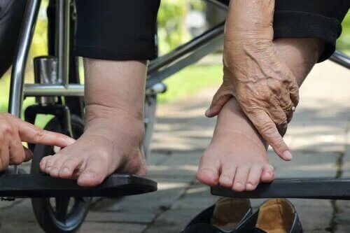 Conseils pour prendre soin de votre pied diabétique pendant l'été
