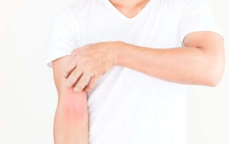 Un cas de rash cutané sur le bras. 