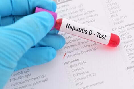 Les hépatites virales peuvent être diagnostiquées grâce à des analyses.