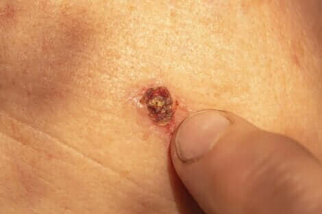 Pour quelles raisons les verrues saignent-elles ?