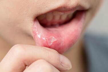 Les aphtes buccaux chez les enfants : comment les traiter ?