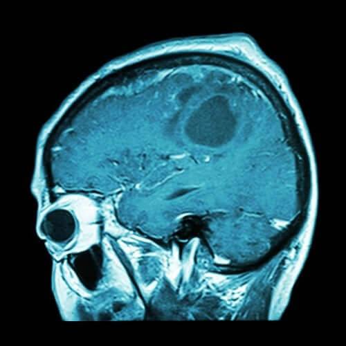 Bientôt un vaccin contre le cancer du cerveau ?
