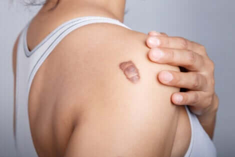 Cicatrice chéloïde.