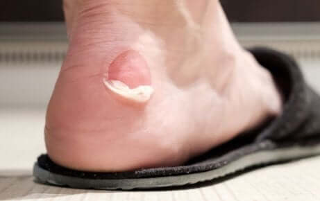 Une cloque au pied.