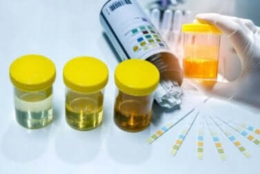 Analyse d'urine.