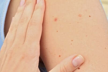 Les taches sur le visages et les grains de beauté.