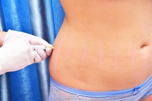 Qu'est-ce que la lipothérapie et à quoi sert-elle ?