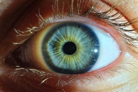 Myosis dans un oeil.