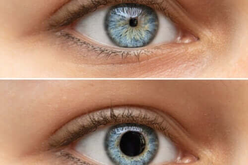 Causes des pupilles punctiformes ou myosis