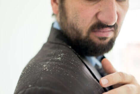 Les pellicules chez un homme.