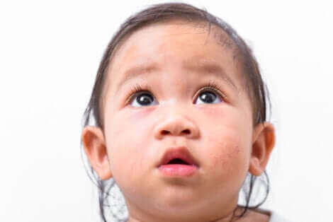 Un enfant qui a une maladie de peau.