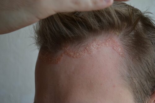 Poussée de psoriasis sur le cuir chevelu.